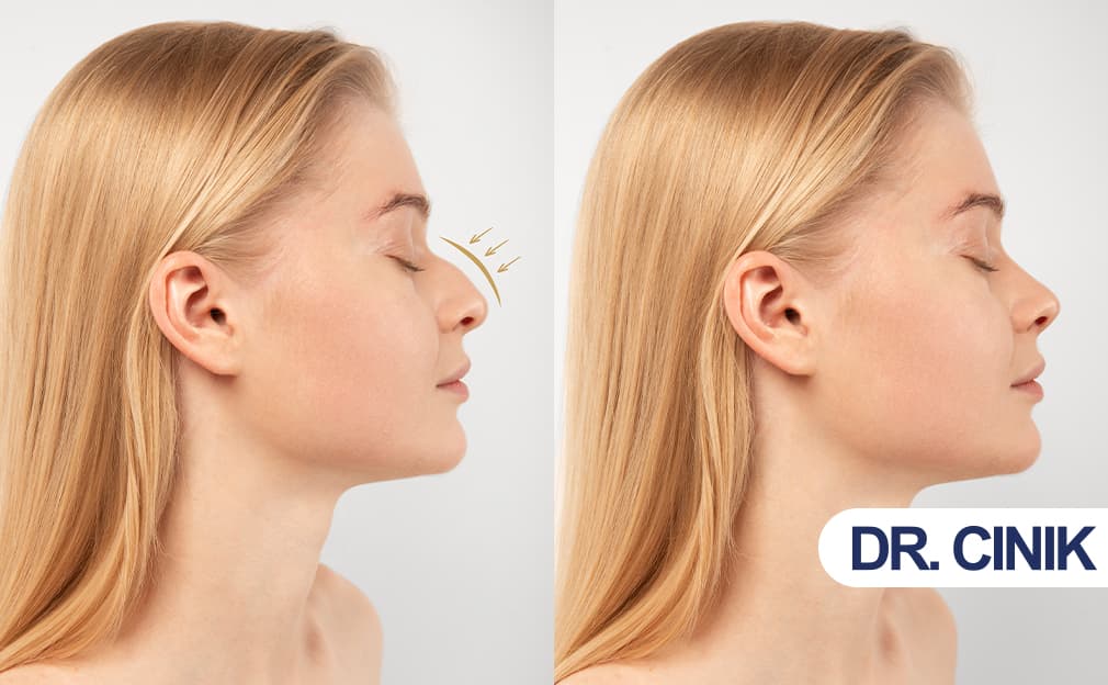 What is Nose Filler?