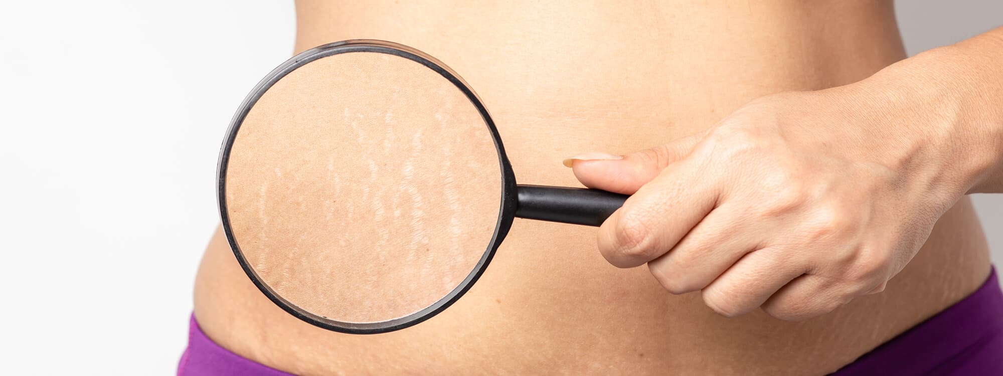 Stretch Mark Treatment