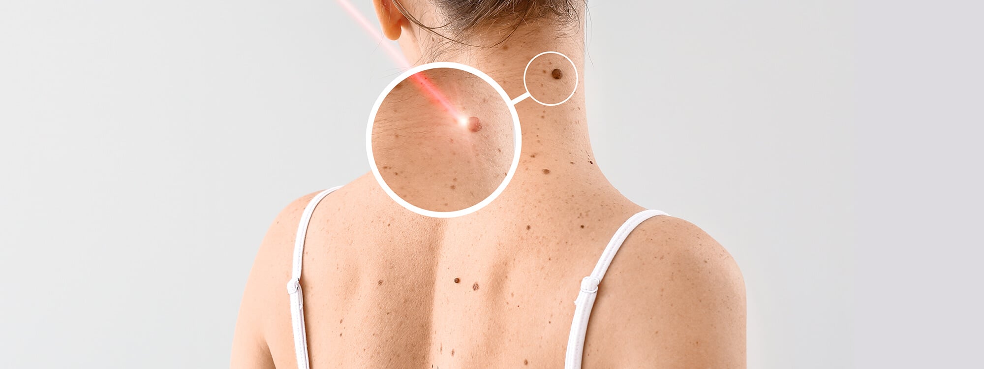 Mole (Nevus) Treatment