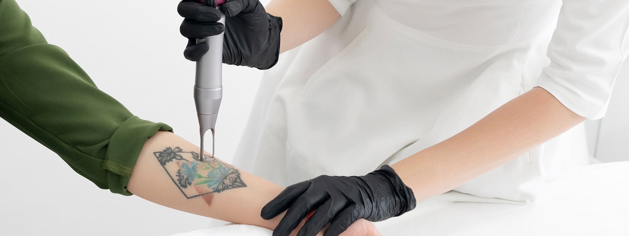 Tattoo Removal