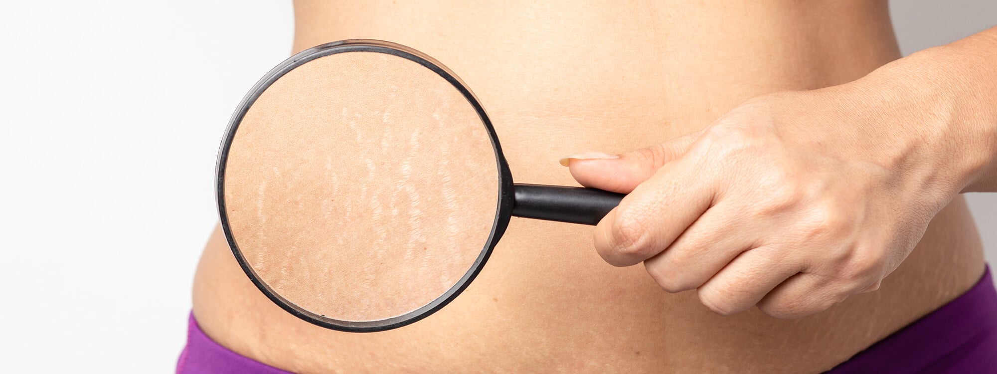 Stretch Mark Treatment