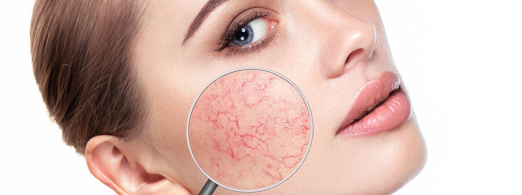 Rosacea Treatment
