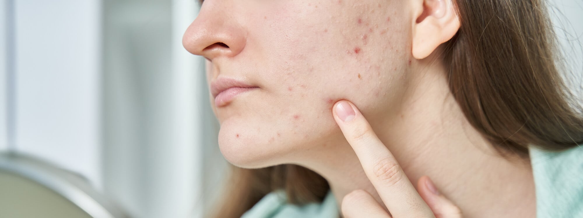 Acne Scar Treatment